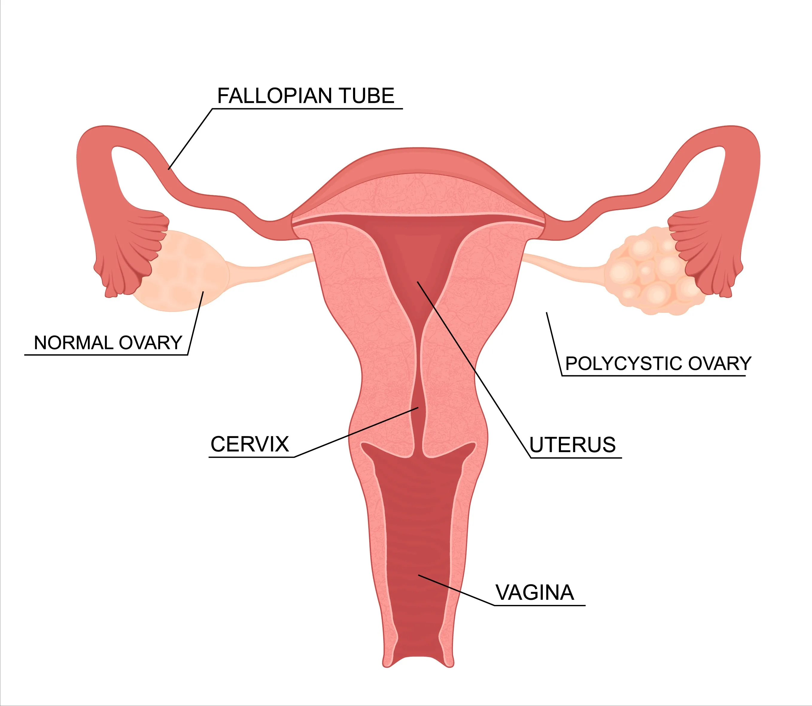 PCOS