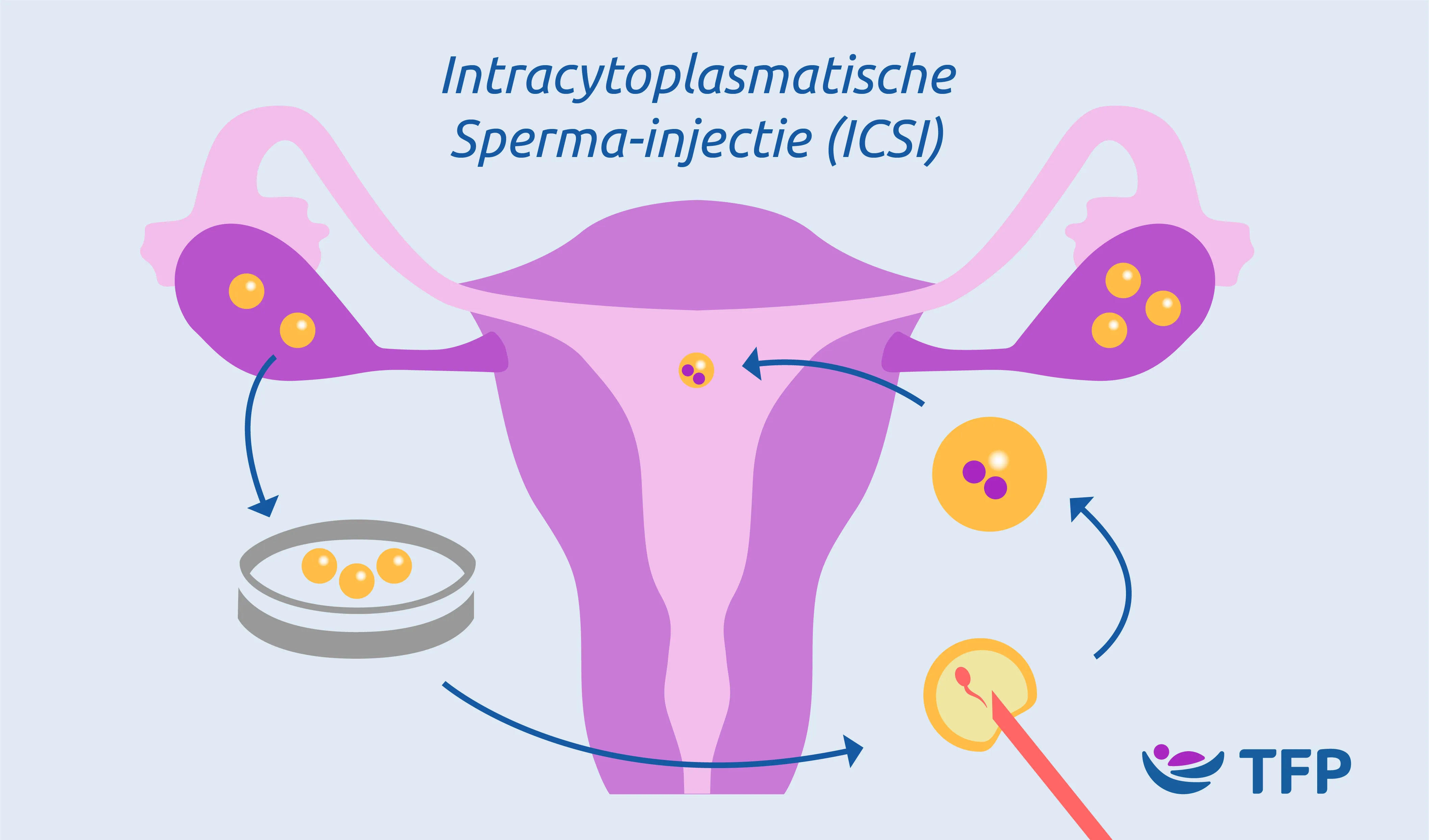 ICSI | TFP 